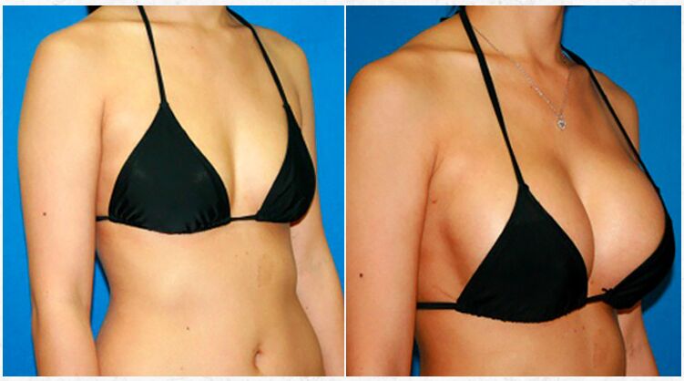 Before and after breast augmentation by plastic surgery
