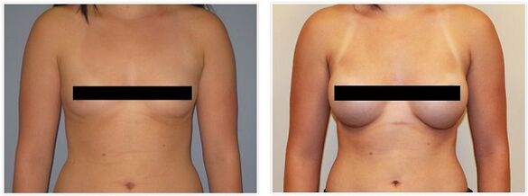 breasts before and after surgery