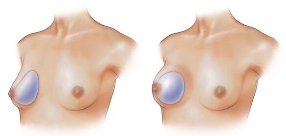 drop-shaped and round implants for breast augmentation