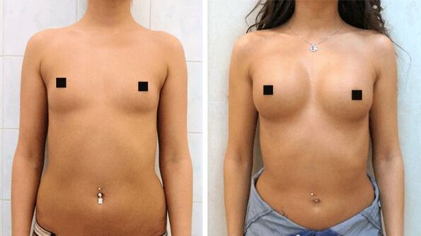 photos before and after surgical breast augmentation